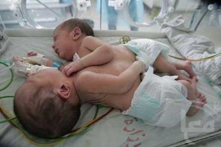  تولد نوزادان دوقلوی به هم چسبیده +عکس